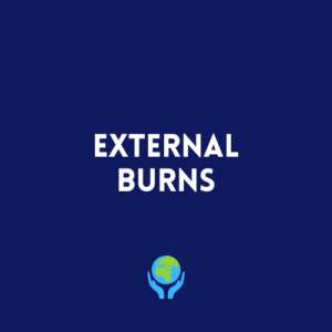 External Burns