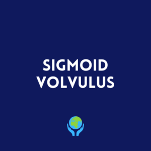 Sigmoid Volvulus